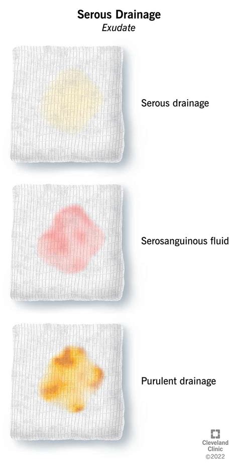 clear fluid leaking from leg|Serous Wound Drainage